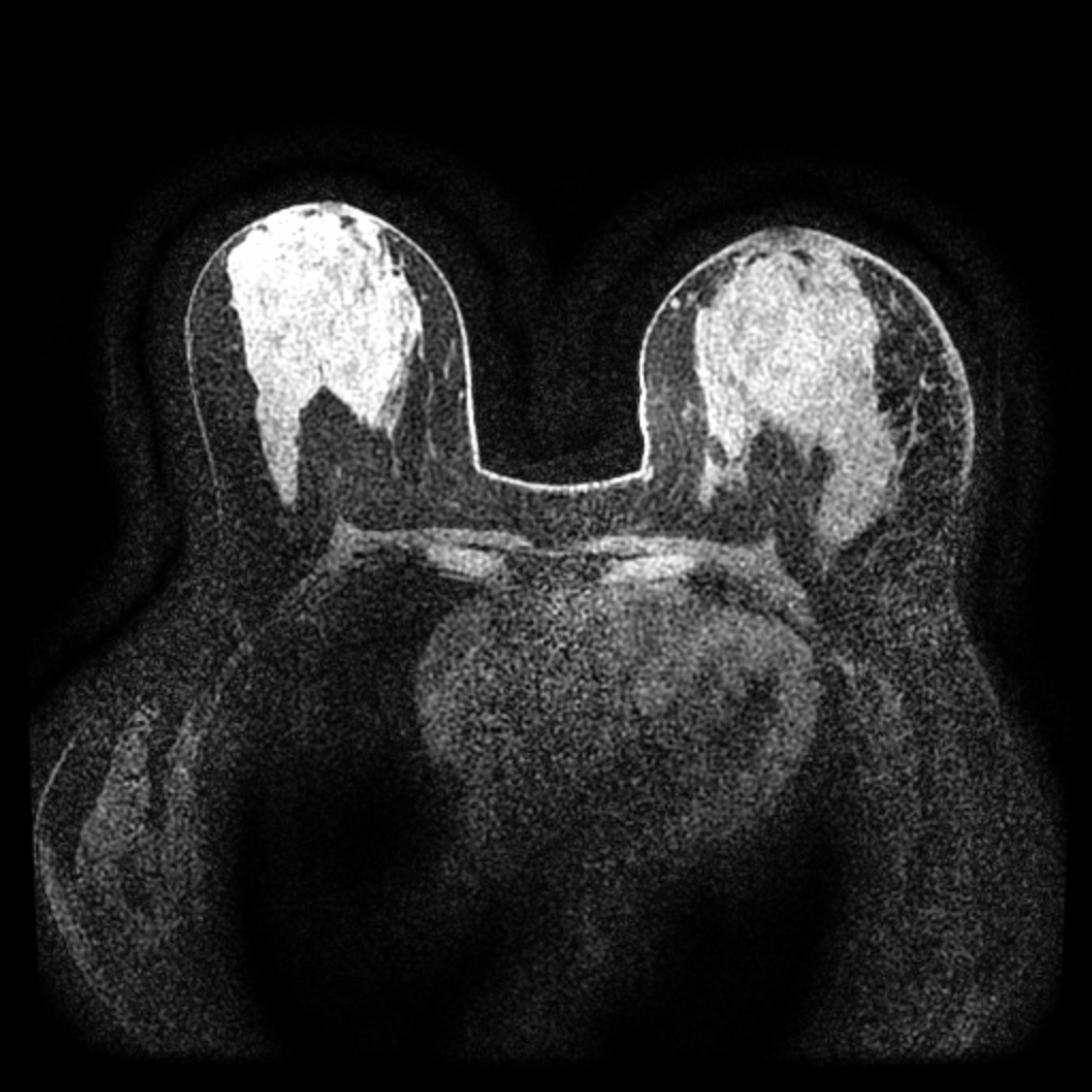 Pre-contrast MRI